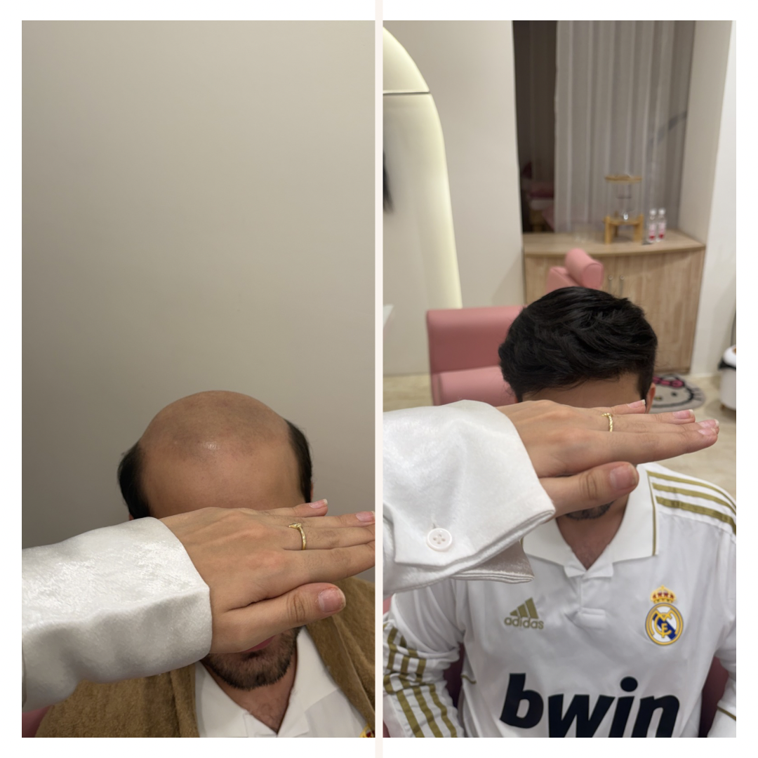 Hair Patch Before & After
